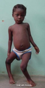 Child with rickets Photo courtesy wwwfreegrabnet